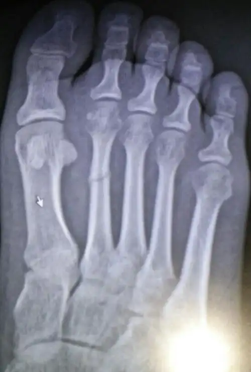 上个月4号受伤,打石膏半个月,昨天复查的片子骨痂是不是很少?对位