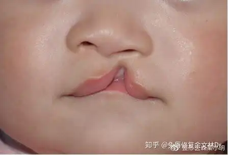 兔唇在几个月可以查出