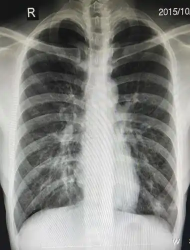 支气管炎改变这个词往往都是在影像学报告上所说的,就是说从胸片