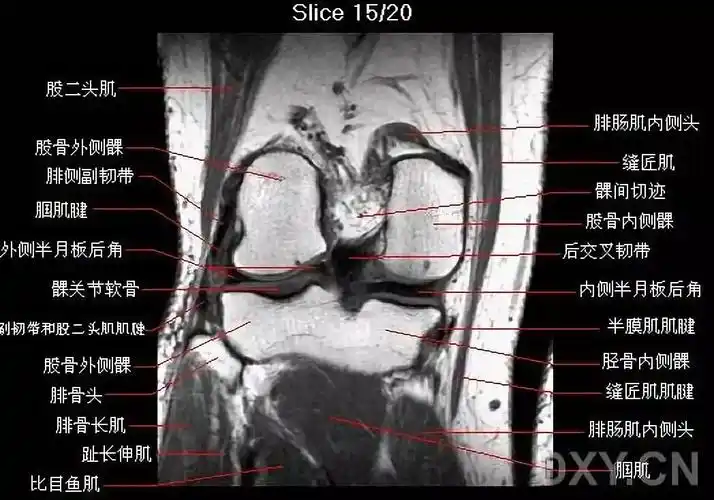 ②内侧副韧带位于冠状层面中部,走行于股骨内侧髁及胫骨上端的内侧