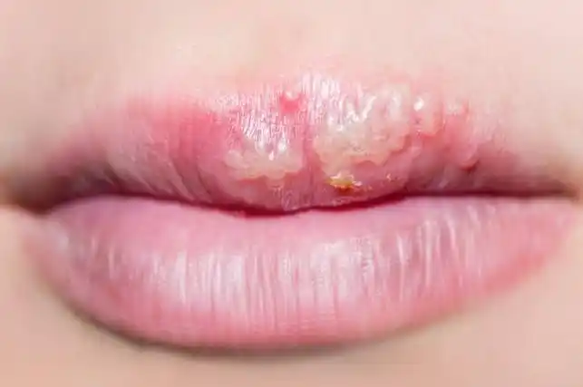 千万别忽略嘴角的小水泡 皮肤科医生为你科普单纯疱疹