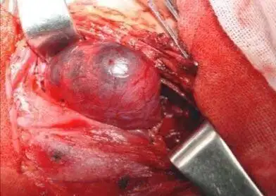 甲状腺瘤需要补充什么物质啊并