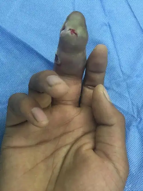 一例感染性腱鞘炎患者的讨论 [病例帖]