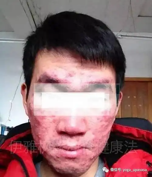 美容养颜案例调理脸部痤疮改善体质