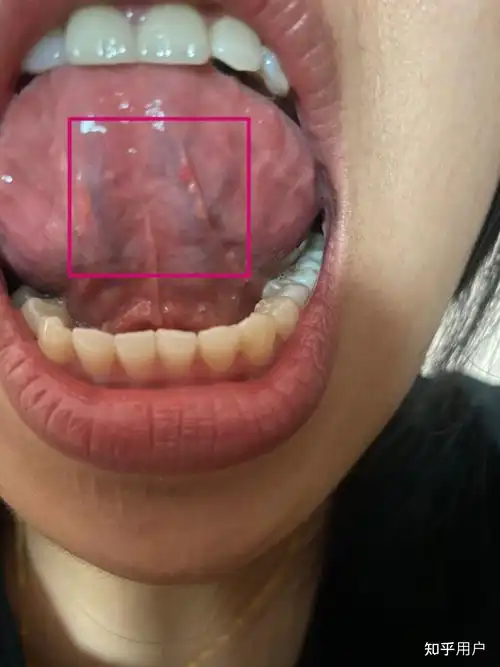 舌头底下起了疙瘩是什么原因? - 知乎