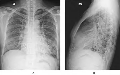 支气管扩张典型影像学表现