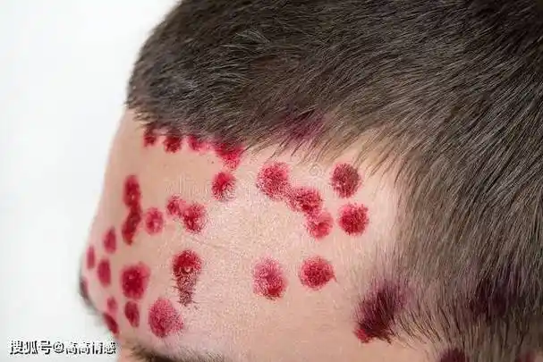 艾滋病的"隐身"时间,别再把它当成皮肤病了!_检测_患者_进行