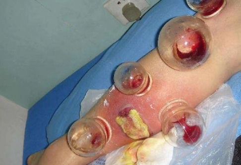 蜂窝组织炎图片55