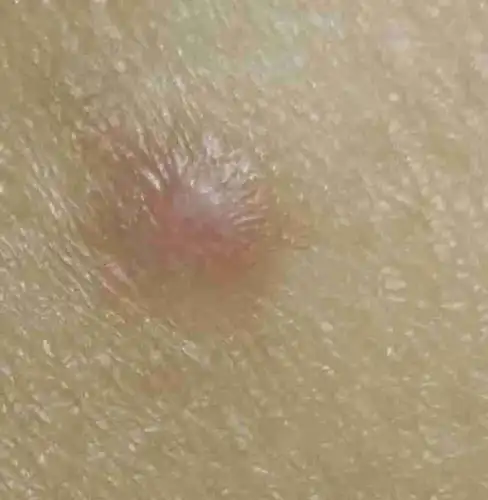 小疙瘩中间还有个针眼?