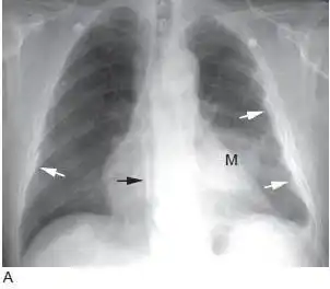 肺癌的影像学表现(上)(多图)