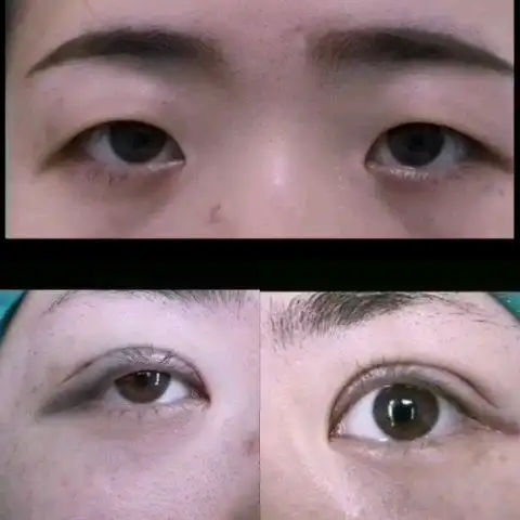 落日眼让人非常没有精神,双眼皮一做就大不同了,当别人都漂亮了您还在