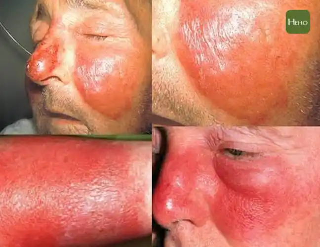 图说/丹毒会导致皮肤红肿