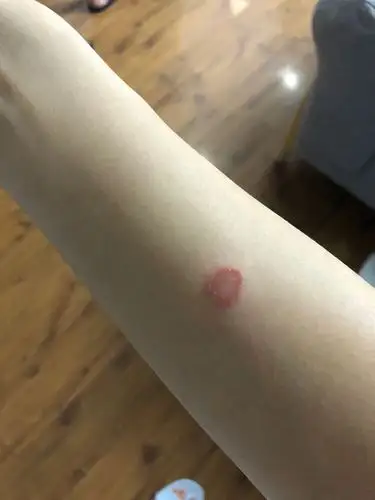 记录去猫癣过程