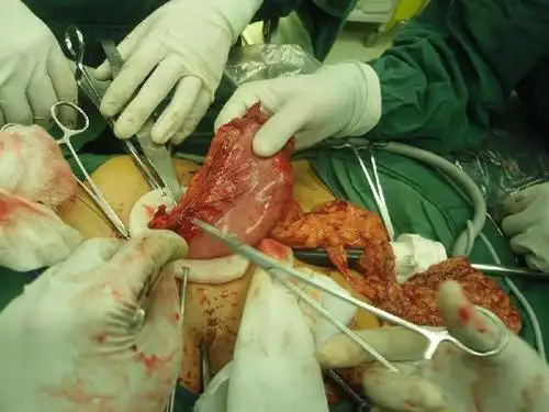 胃癌根治术的术后饮食注意事项