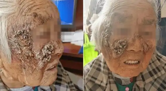 病例夹老年斑竟然长成了皮肤癌