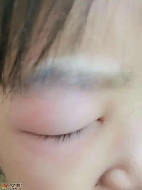 早上起来,眼睛肿成这样,是被夜蚊子亲了吗?