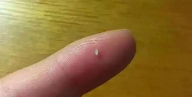 痘痘挤出白色小米粒请别忽视不然脸可能就毁了