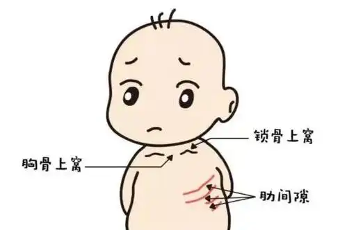 😷小儿急性喉炎:家长须知与预防措施