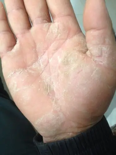 皮肤病.手掌现在还是起皮干裂 疼痛 不知道怎么办