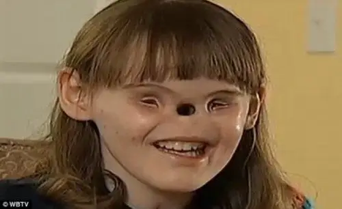 女孩患天生缺鼻子少眼揭全球罕见怪病图