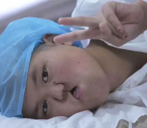 换脸第一步手术过程