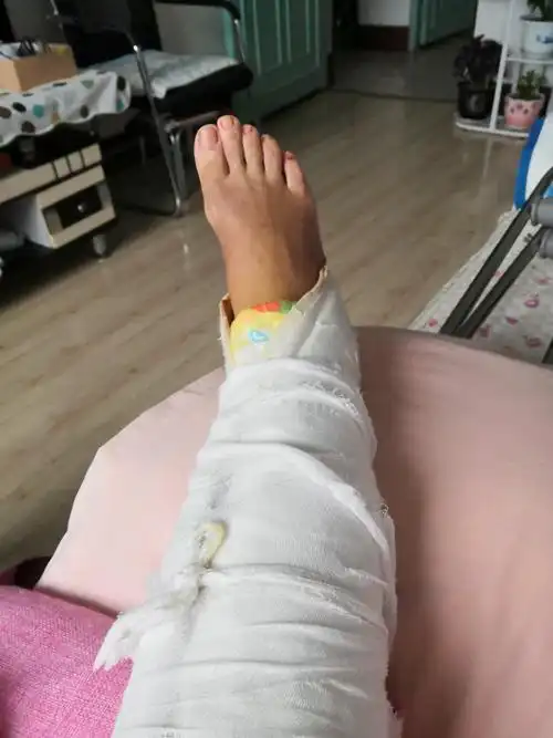 2020年3月8日,不慎摔了一跤,造成右腓骨下段斜行骨折,没有错位,石膏