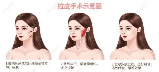 小切口拉皮手术示意图 图源www.17qzx.com