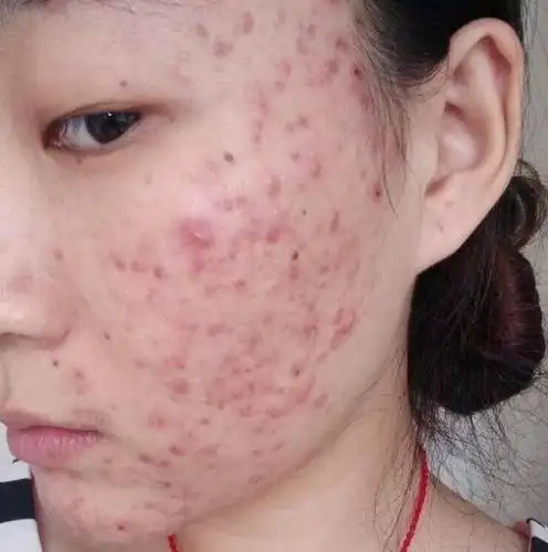 特别是在下午时,抬头一看可能都被自己脸上的油吓到了,这是螨虫在刺激