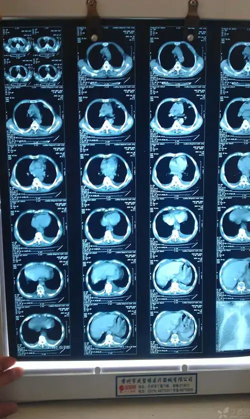 肺结核? [病例帖]