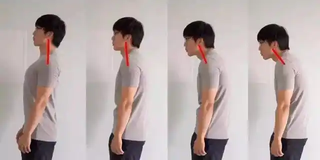 宝宝驼背是怎么回事小孩驼背是怎么回事