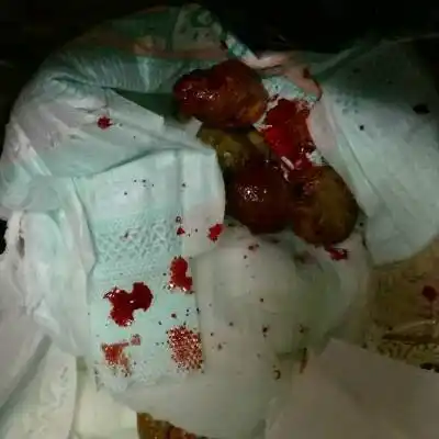 今早大便出血比较多,怎麼处理?