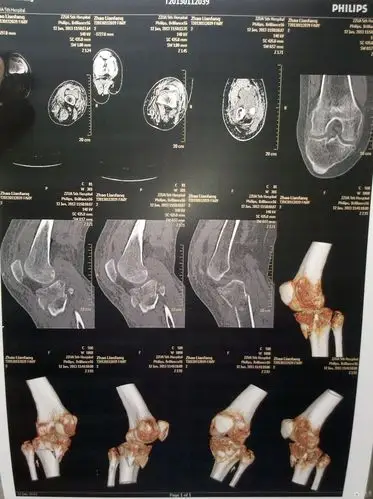 左侧胫骨平台骨折,请看片.
