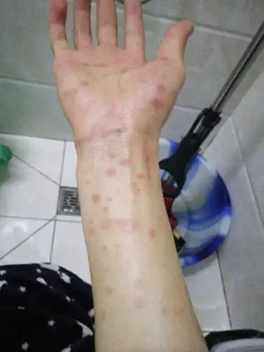 医生您好请问一下这个是梅毒吗?