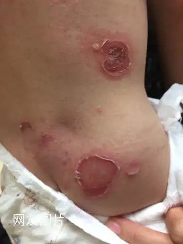 儿童脓疱病……需要就诊吗
