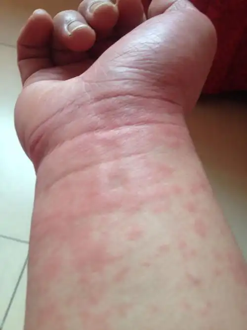 昨天手上就起了许多小红点,不痛不痒的.