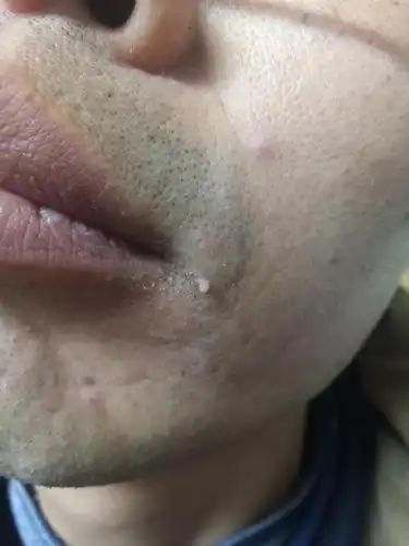 最近发现嘴角长个肉剌,不痛也不痒,手捏肉刺也会痛,具体见图.