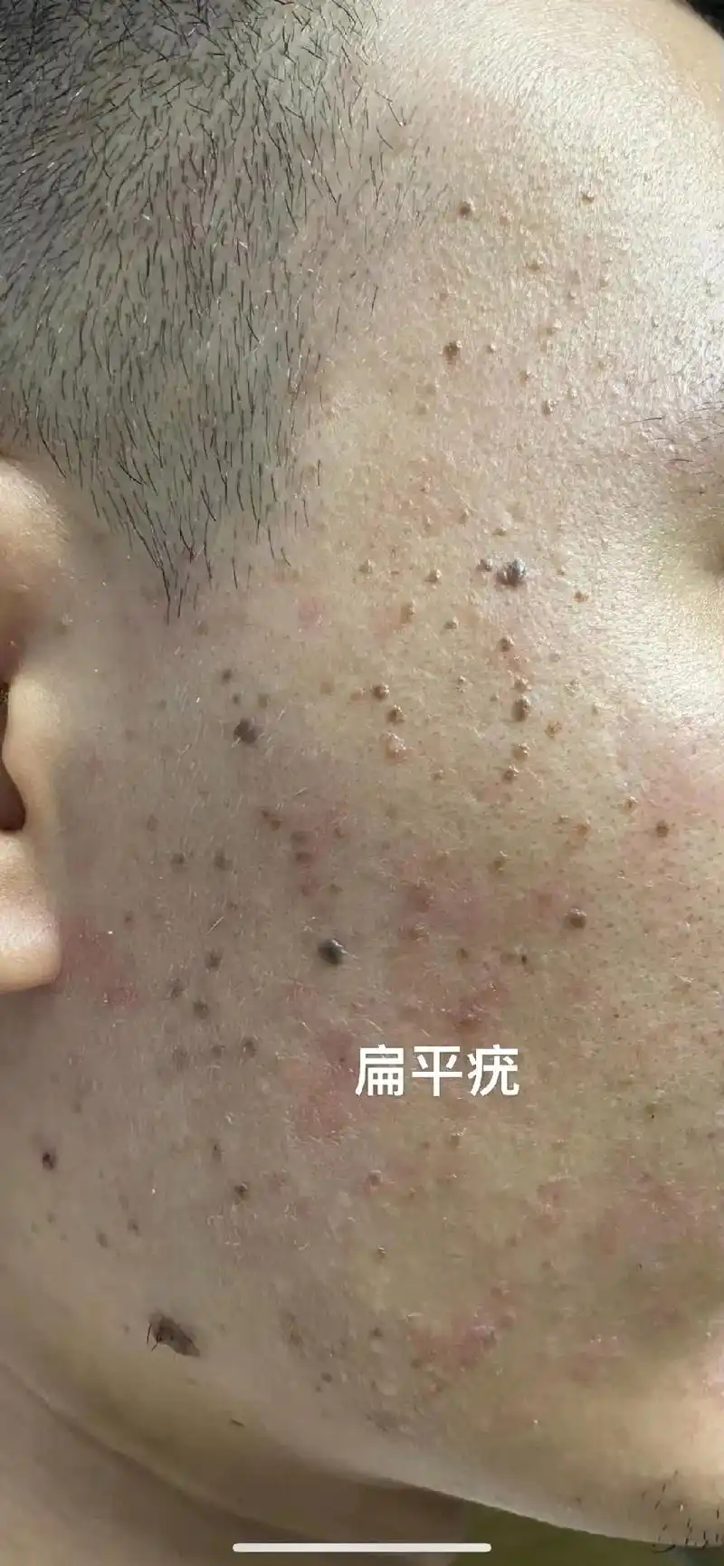 扁平疣 人身上长了"疣"——扁平疣,矢状疣,寻常疣,如果不 - 抖音