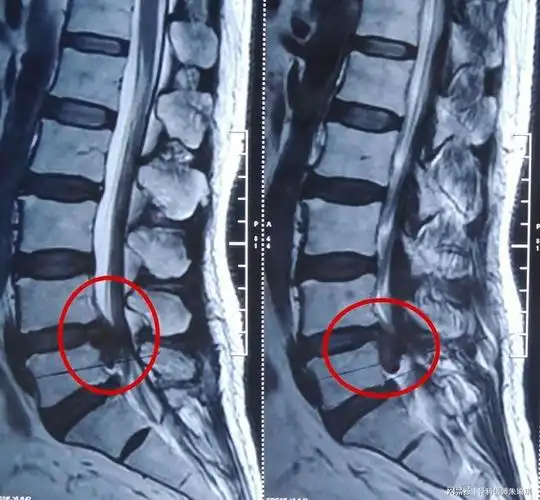 医生|治疗|腰椎间盘突出_网易订阅