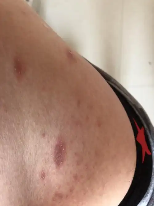 身上起这种疙瘩是什么原因?