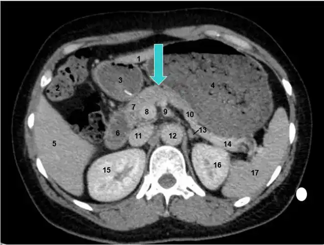 胰腺颈部:胰头,体之间狭窄而扁薄的部分.