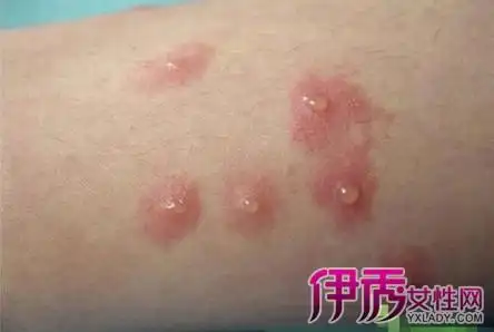 【图】尖锐湿疣初期图片 三点教你认识疾病早期症状