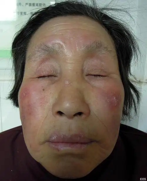颜面部红斑2年余