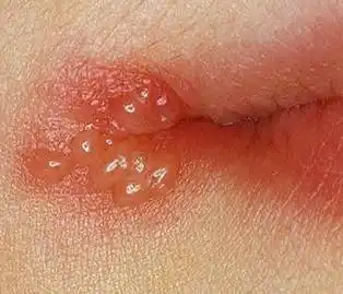 生殖器疱疹对妊娠对顺产会有影响吗?如何最大限减少对宝宝伤害?