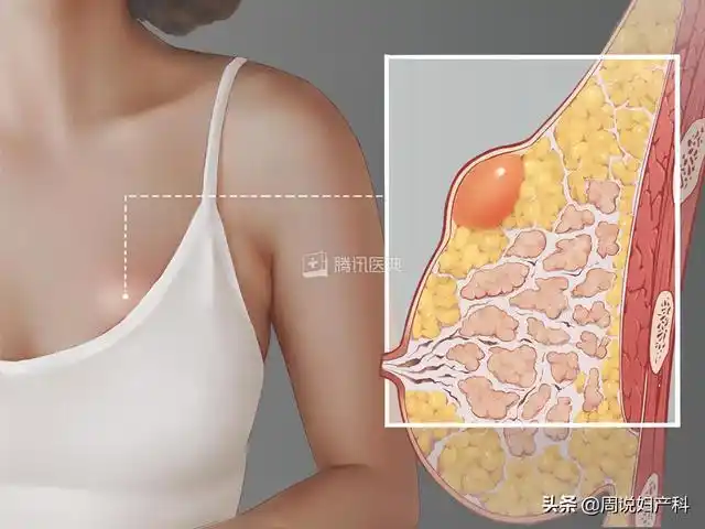 记得先做这件事|乳腺|囊肿|增生|乳头|乳腺癌_网易订阅