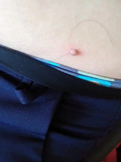 大家好,我从小腹部这块就有个小肉球,没当回事,今年三十几了,摸着有点