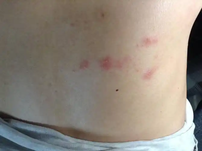 没想到3天后症状加重,就近去医院看了急诊,医生诊断为带状疱疹,开了