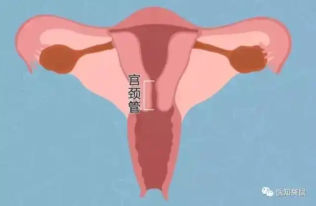 你的宫颈管长度正常吗?