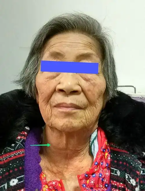 甲状腺肿瘤的二三事