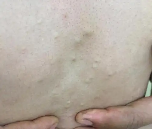 胸部起了好多疙瘩挤出来一闻没有臭味这是啥呢