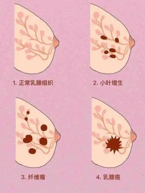 乳腺结节离乳腺癌有多远